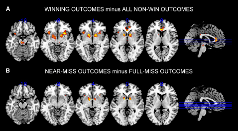 近失效应的 fMRI 证据：A 面板为真赢对比非赢的结果，B 面板为近失对比全输的结果，两相比较可见腹侧纹状体等赢钱相关区域都被激活
